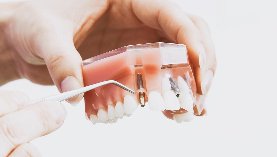 Person Demonstrating Dental Implants